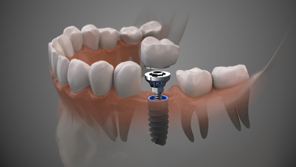 Securely Replace Missing Teeth With Dental Implants