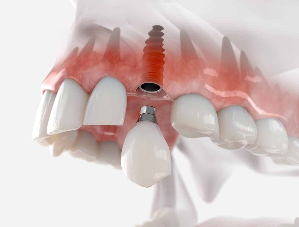 5 Bad Habits to Avoid with Dental Implants