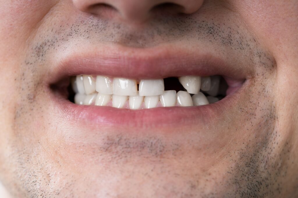 The Importance of Replacing Missing Teeth for Oral Health